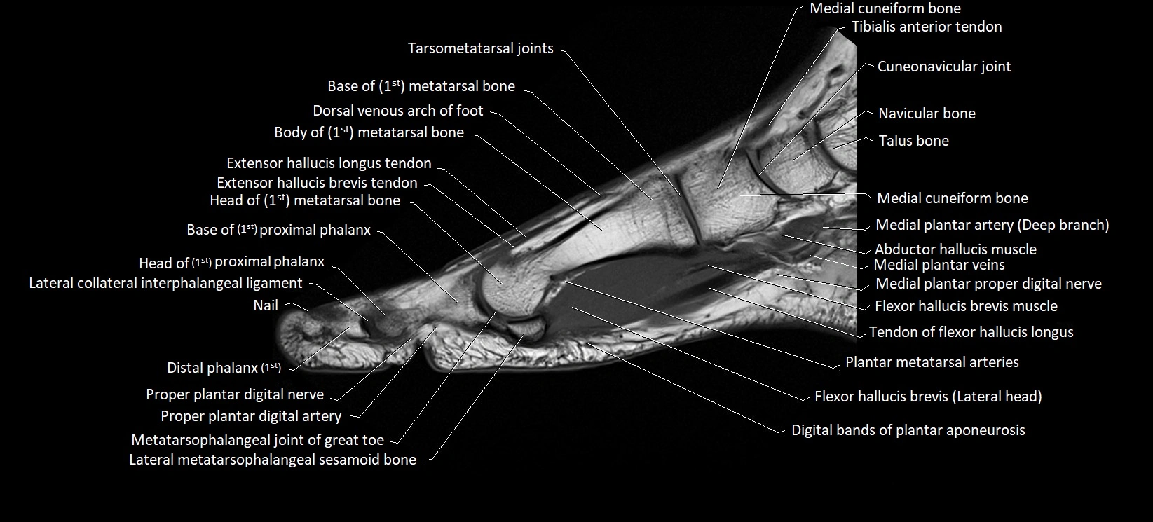 MRI foot sagittal labelled cross sectional anatomy image  7.webp